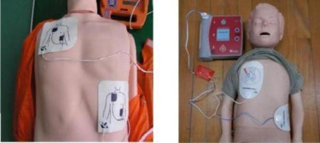 写真：電極パッドの装着例1