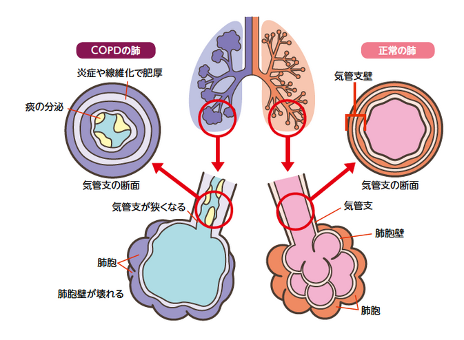 イラスト：COPDの肺　正常の肺