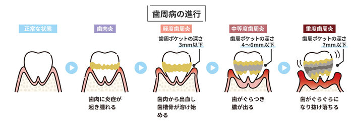 歯周病の過程
